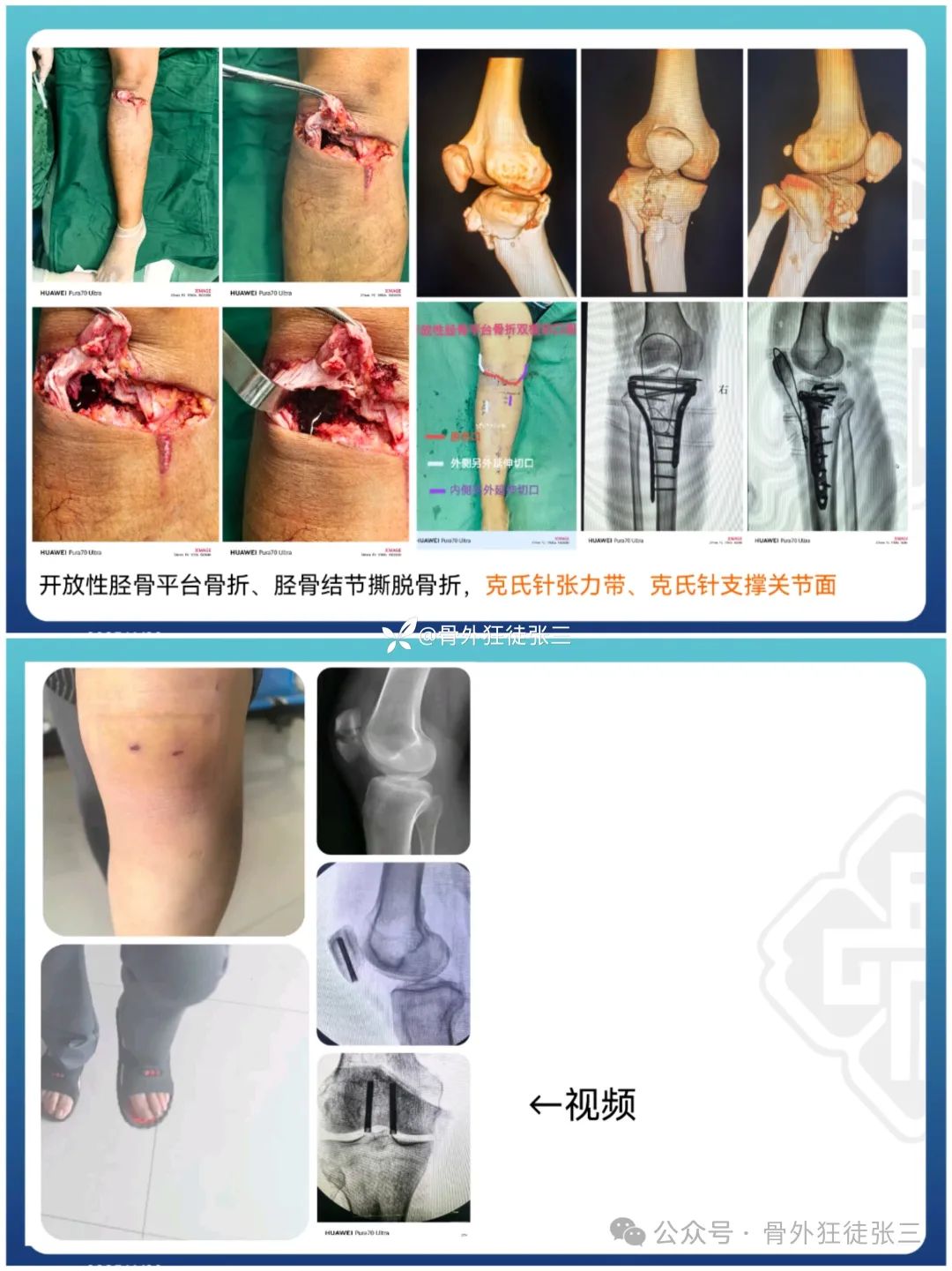 “针”人“针”事----万能克氏针在创骨科的应用