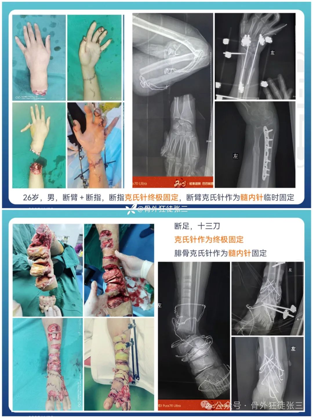 “针”人“针”事----万能克氏针在创骨科的应用