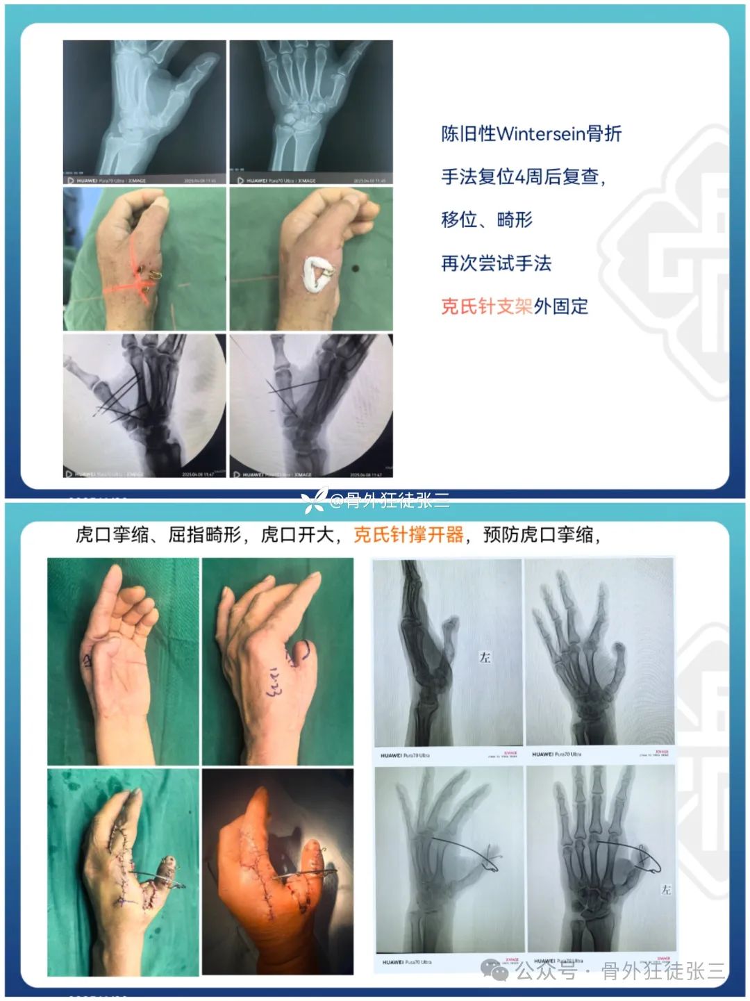 “针”人“针”事----万能克氏针在创骨科的应用