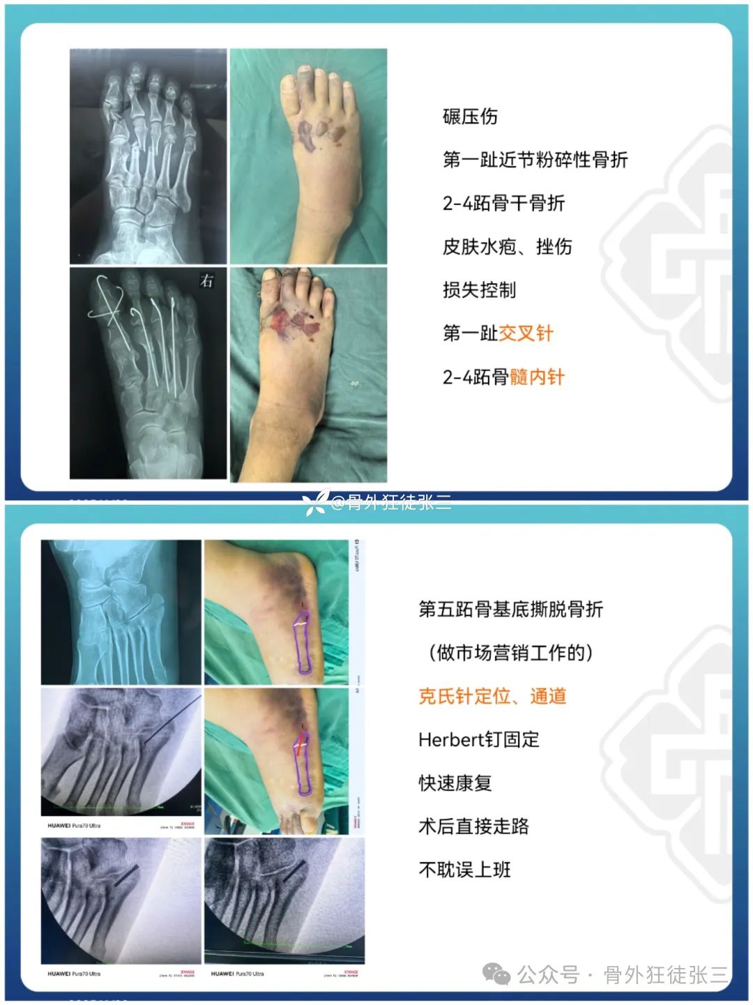 “针”人“针”事----万能克氏针在创骨科的应用