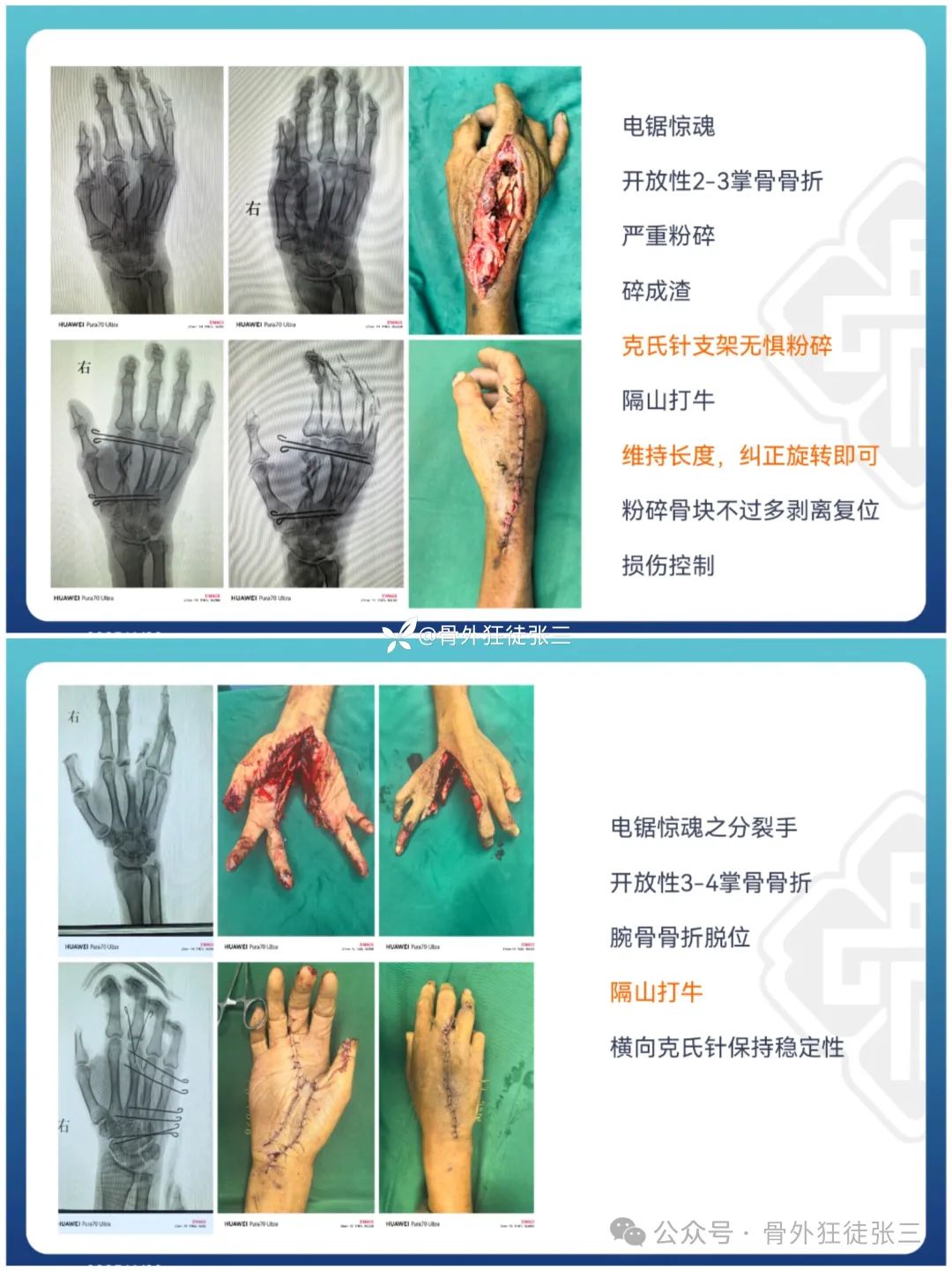 “针”人“针”事----万能克氏针在创骨科的应用