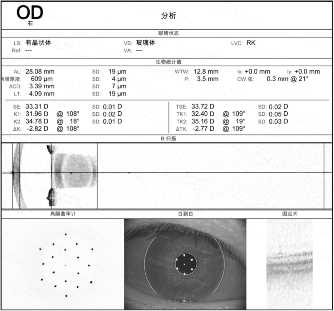 放射状角膜切开术(RK)后行白内障手术