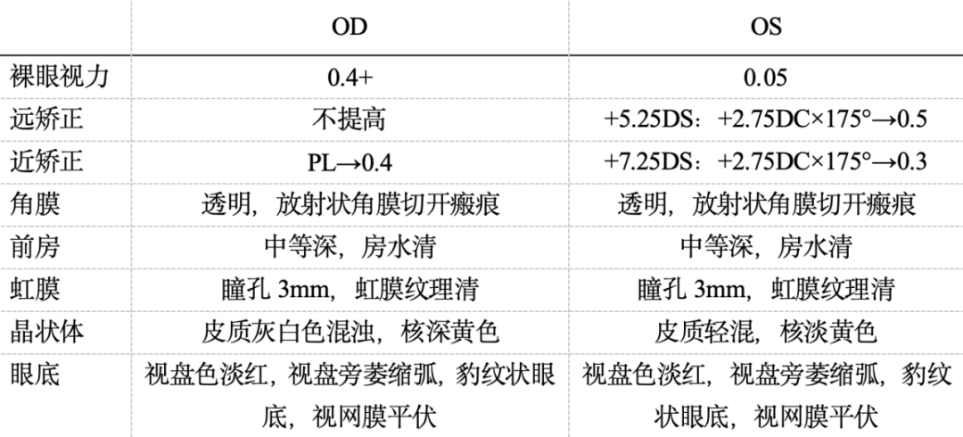 放射状角膜切开术(RK)后行白内障手术