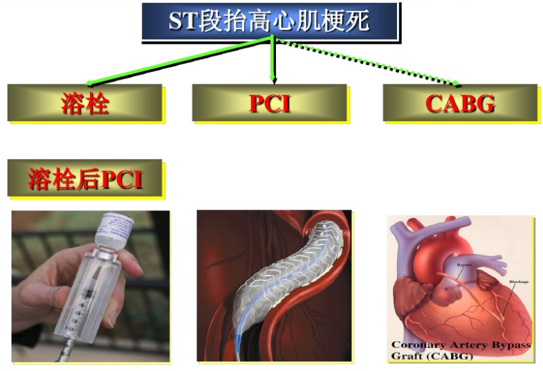 码住！急性心梗的识别与处理