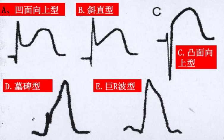 码住！急性心梗的识别与处理