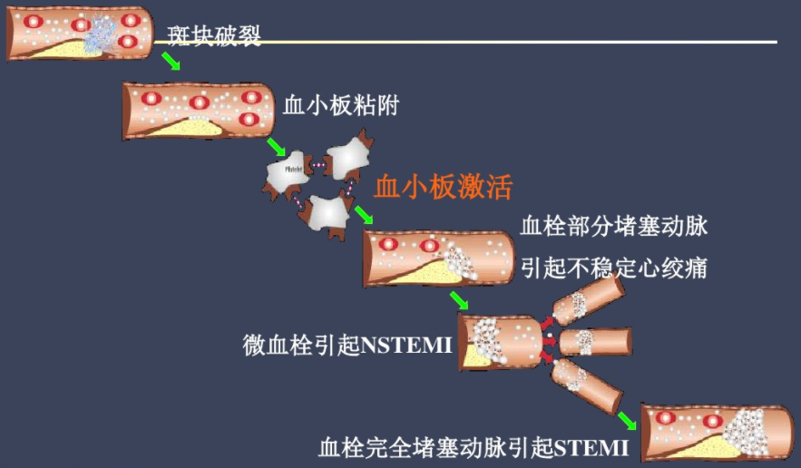 码住！急性心梗的识别与处理