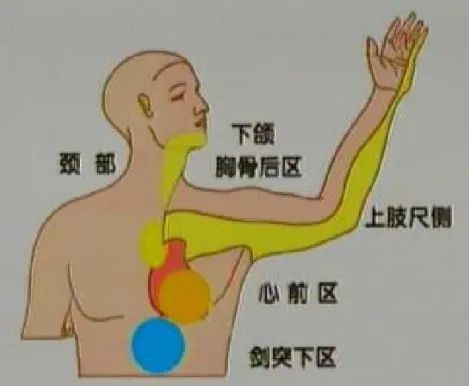 码住！急性心梗的识别与处理