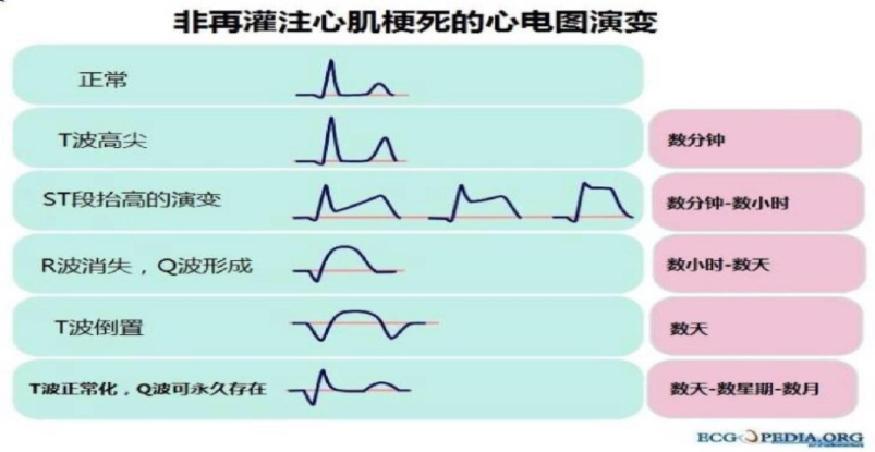 码住！急性心梗的识别与处理