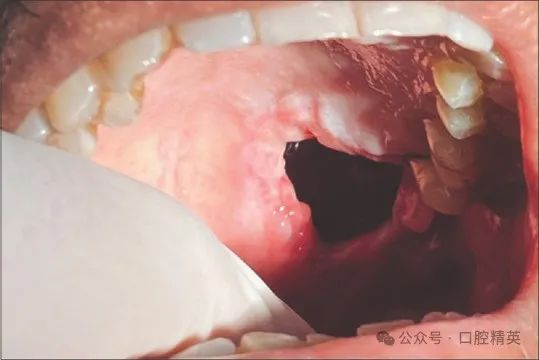 拔除上颌智齿把上颌结节带了下来
