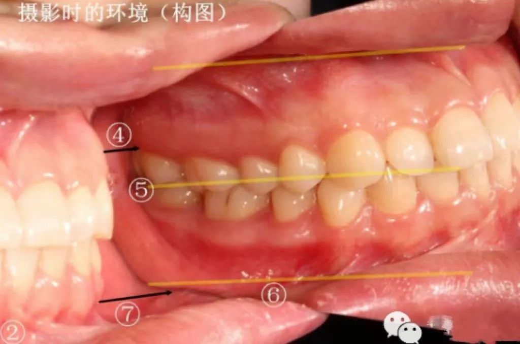 牙医看过来!正畸照片拍摄的正确姿势在这里