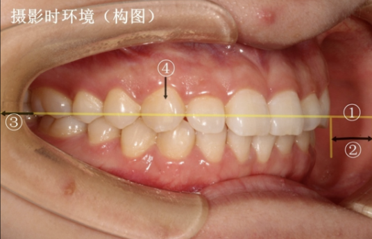 牙医看过来!正畸照片拍摄的正确姿势在这里