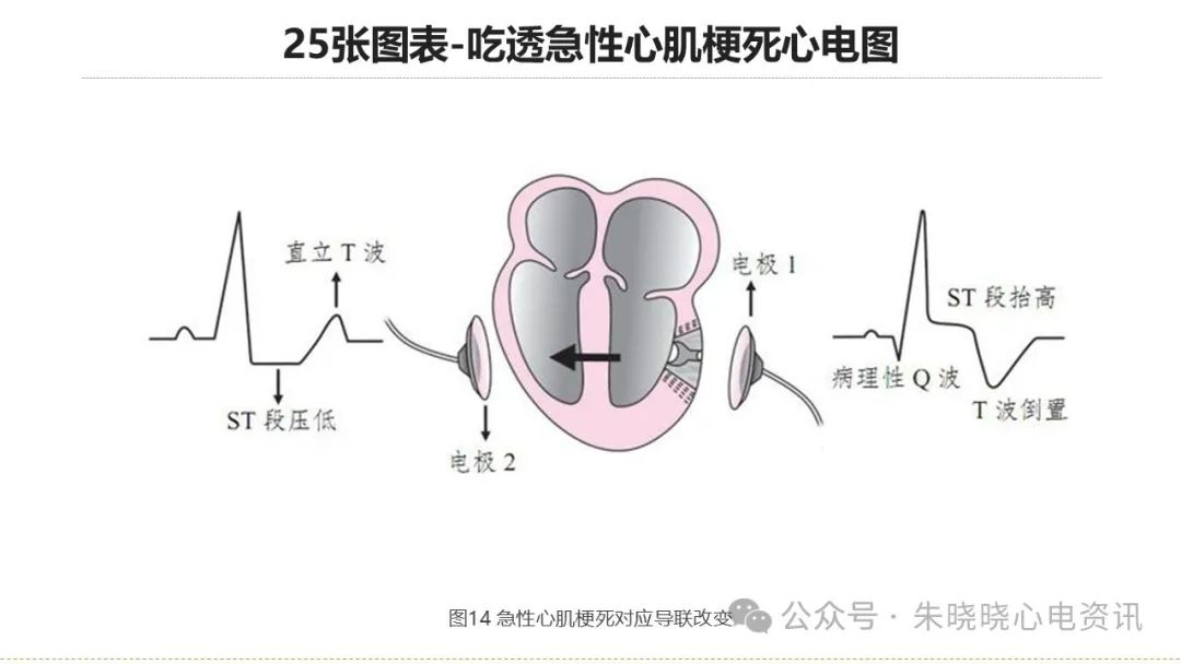 25张图表吃透急性心肌梗死心电图