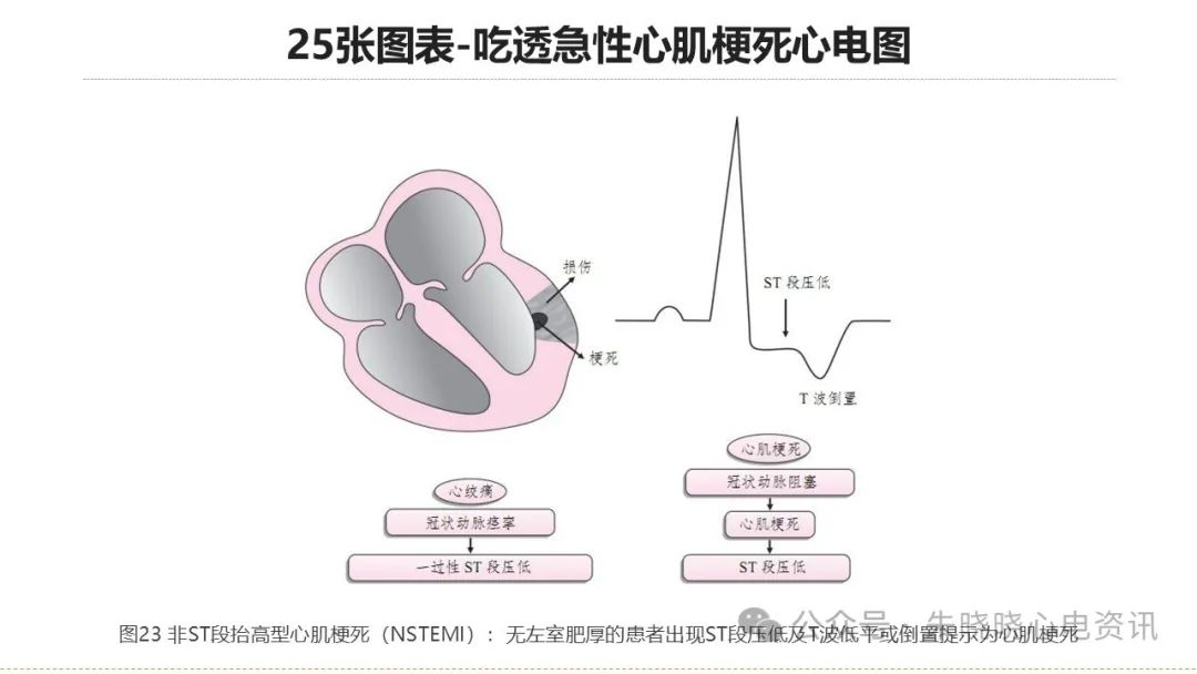 25张图表吃透急性心肌梗死心电图