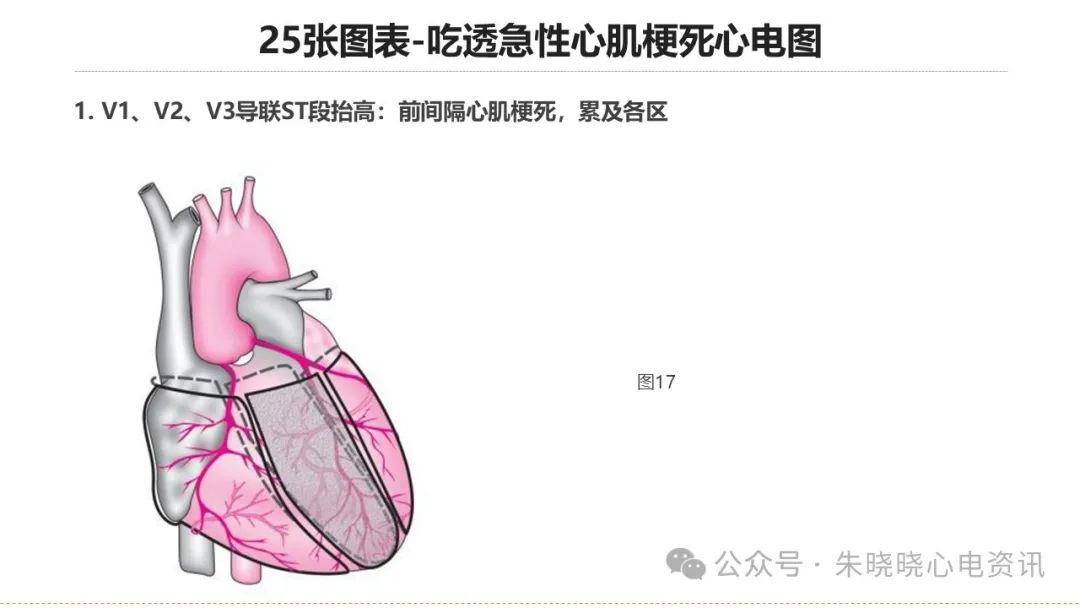 25张图表吃透急性心肌梗死心电图