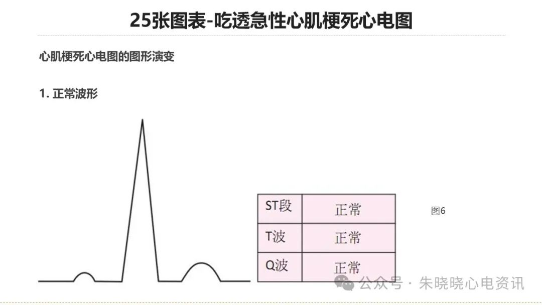 25张图表吃透急性心肌梗死心电图