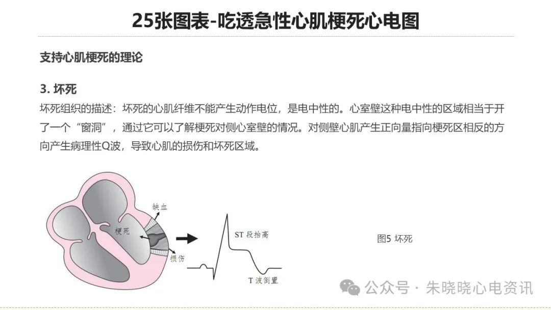 25张图表吃透急性心肌梗死心电图