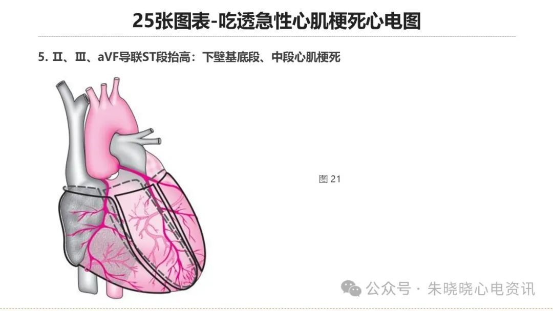 25张图表吃透急性心肌梗死心电图