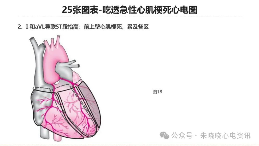 25张图表吃透急性心肌梗死心电图