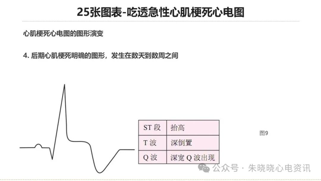 25张图表吃透急性心肌梗死心电图