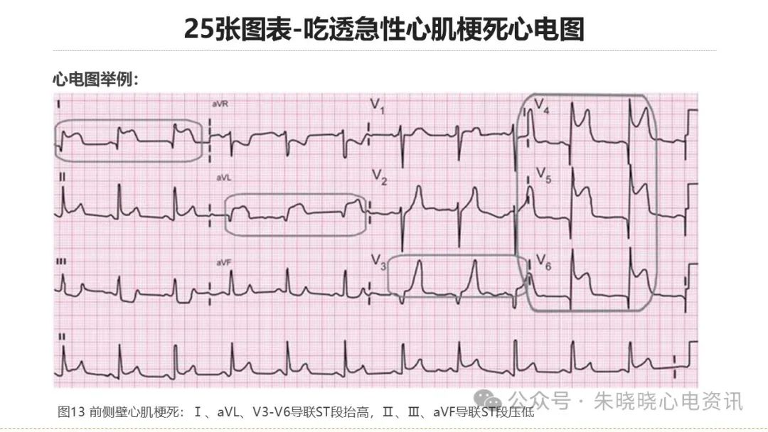 25张图表吃透急性心肌梗死心电图