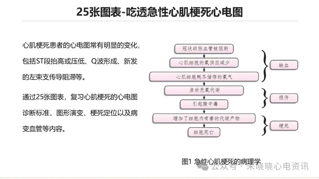 25张图表吃透急性心肌梗死心电图