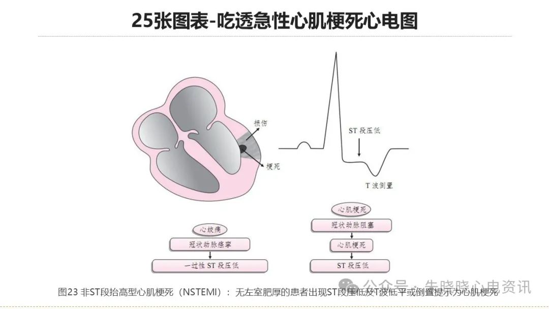 25张图表吃透急性心肌梗死心电图