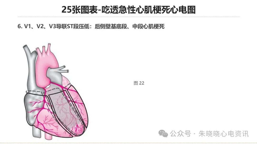 25张图表吃透急性心肌梗死心电图