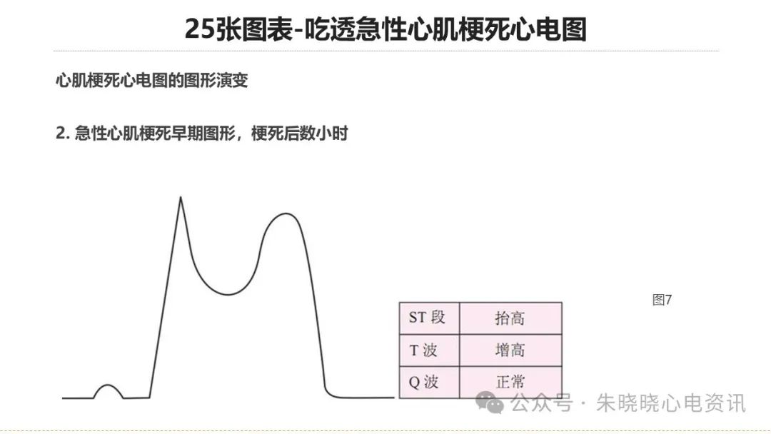 25张图表吃透急性心肌梗死心电图