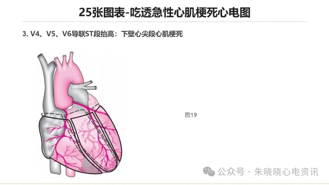 25张图表吃透急性心肌梗死心电图
