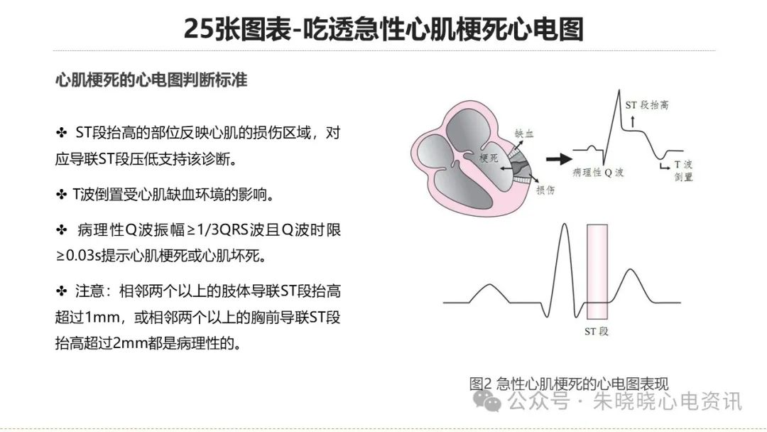 25张图表吃透急性心肌梗死心电图