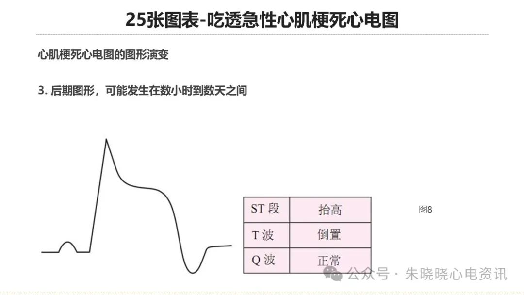25张图表吃透急性心肌梗死心电图