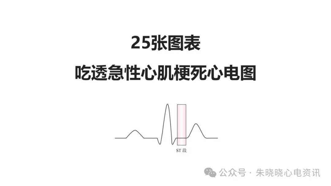 25张图表吃透急性心肌梗死心电图