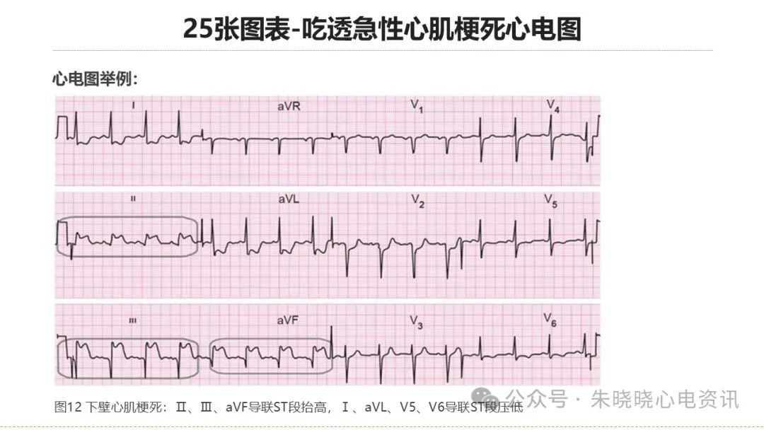 25张图表吃透急性心肌梗死心电图