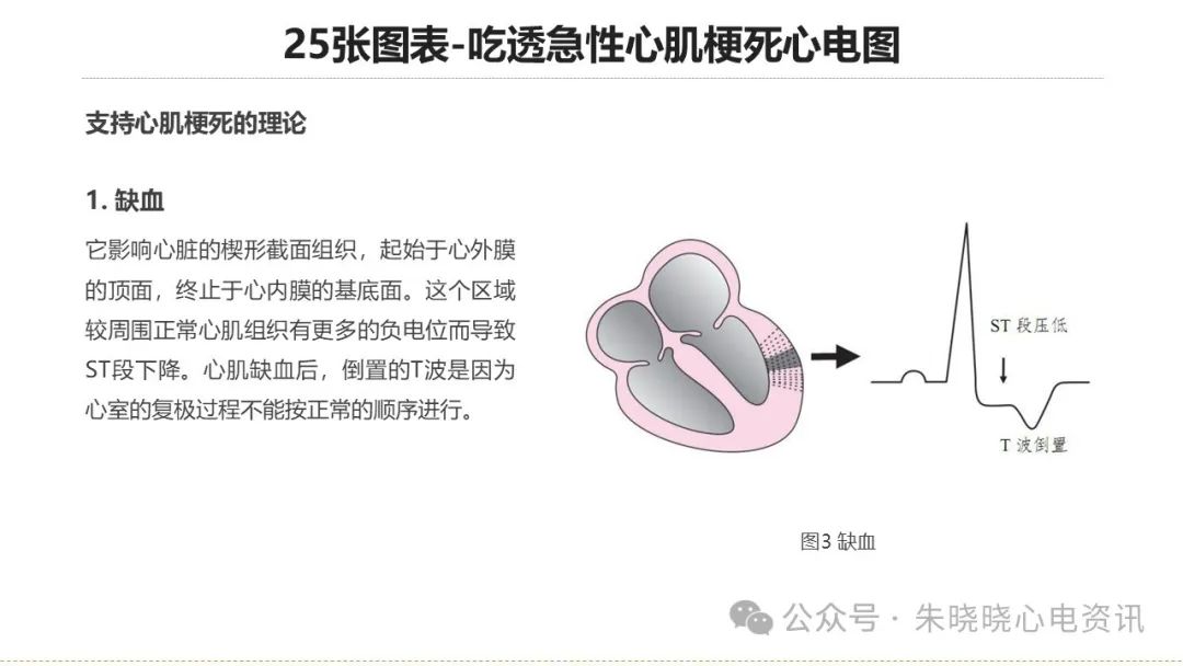 25张图表吃透急性心肌梗死心电图
