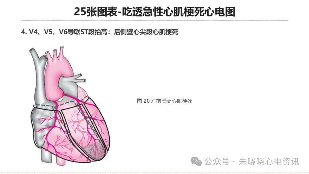 25张图表吃透急性心肌梗死心电图