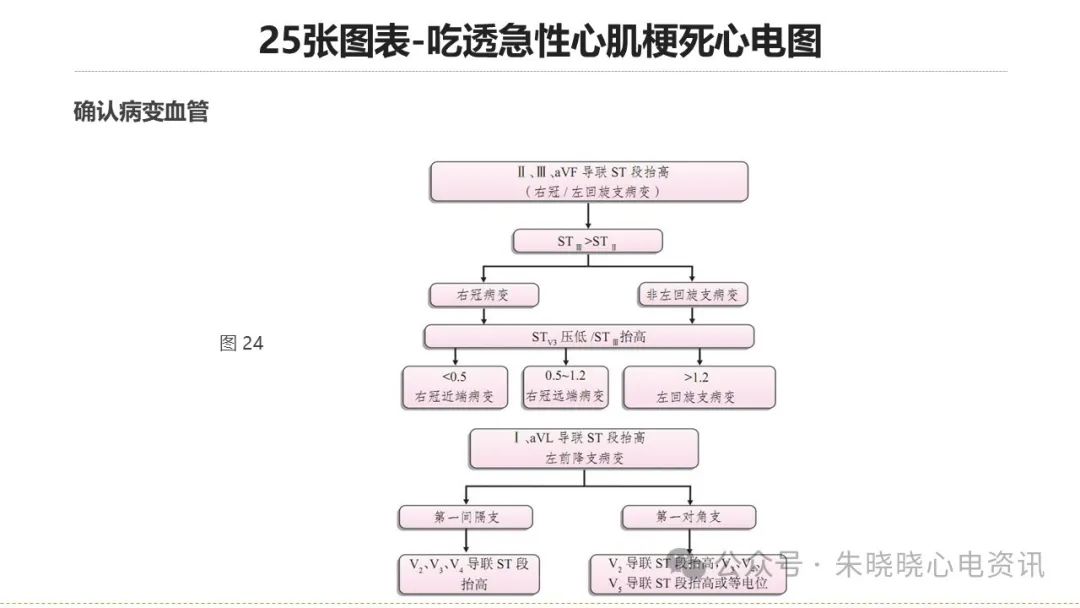 25张图表吃透急性心肌梗死心电图
