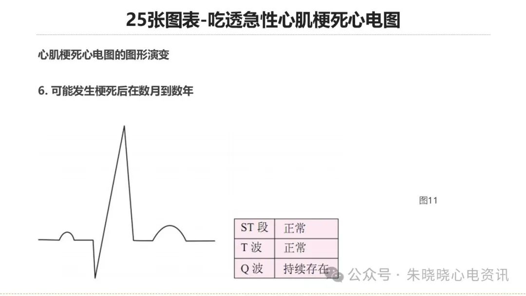 25张图表吃透急性心肌梗死心电图