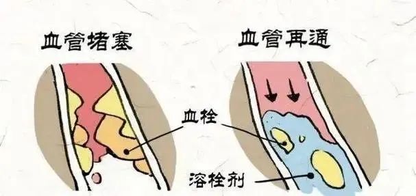 心肌梗死溶栓效果的核心评估指标