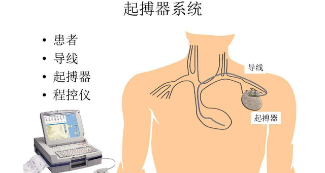 关于心脏起搏器，你了解多少？