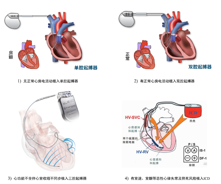 关于心脏起搏器，你了解多少？