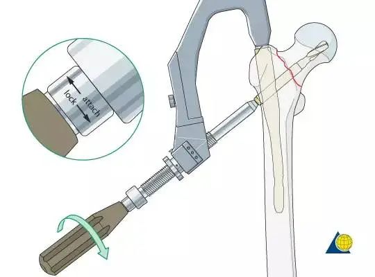 股骨粗隆间骨折PFNA内固定的4大关键总结,实用!