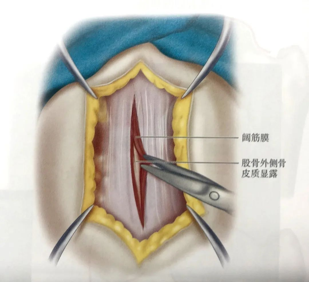 股骨粗隆间骨折PFNA内固定的4大关键总结,实用!