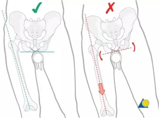 股骨粗隆间骨折PFNA内固定的4大关键总结,实用!