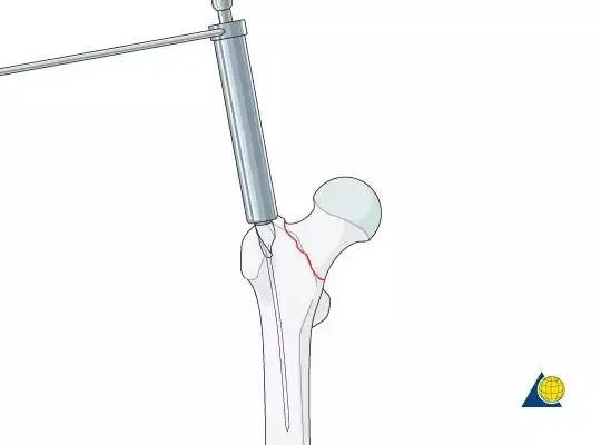 股骨粗隆间骨折PFNA内固定的4大关键总结,实用!