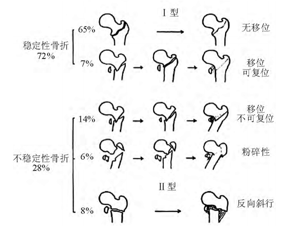 股骨粗隆间骨折PFNA内固定的4大关键总结,实用!
