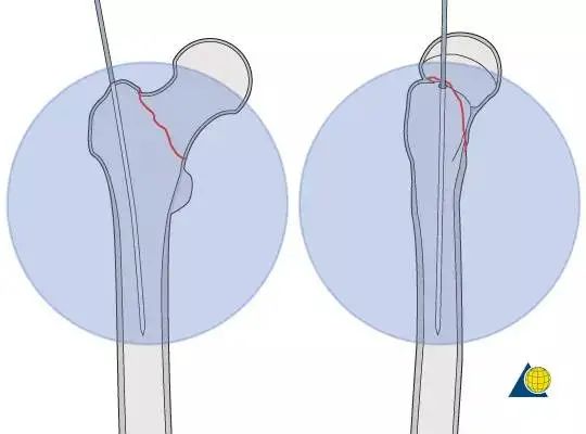 股骨粗隆间骨折PFNA内固定的4大关键总结,实用!