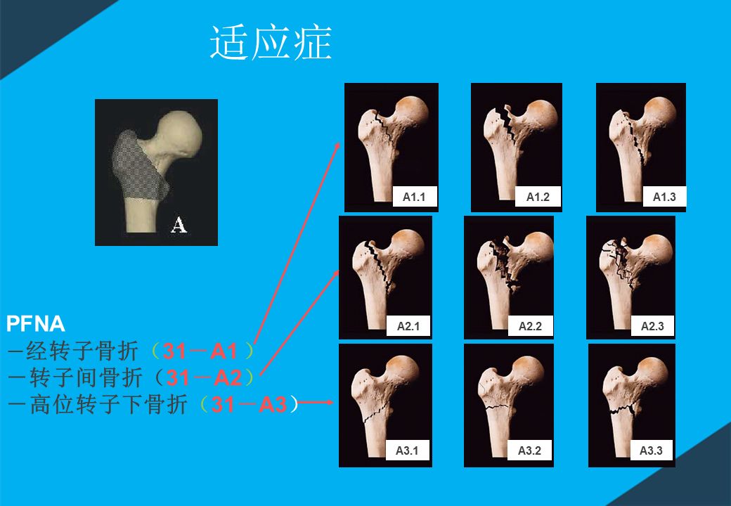 股骨粗隆间骨折PFNA内固定的4大关键总结,实用!