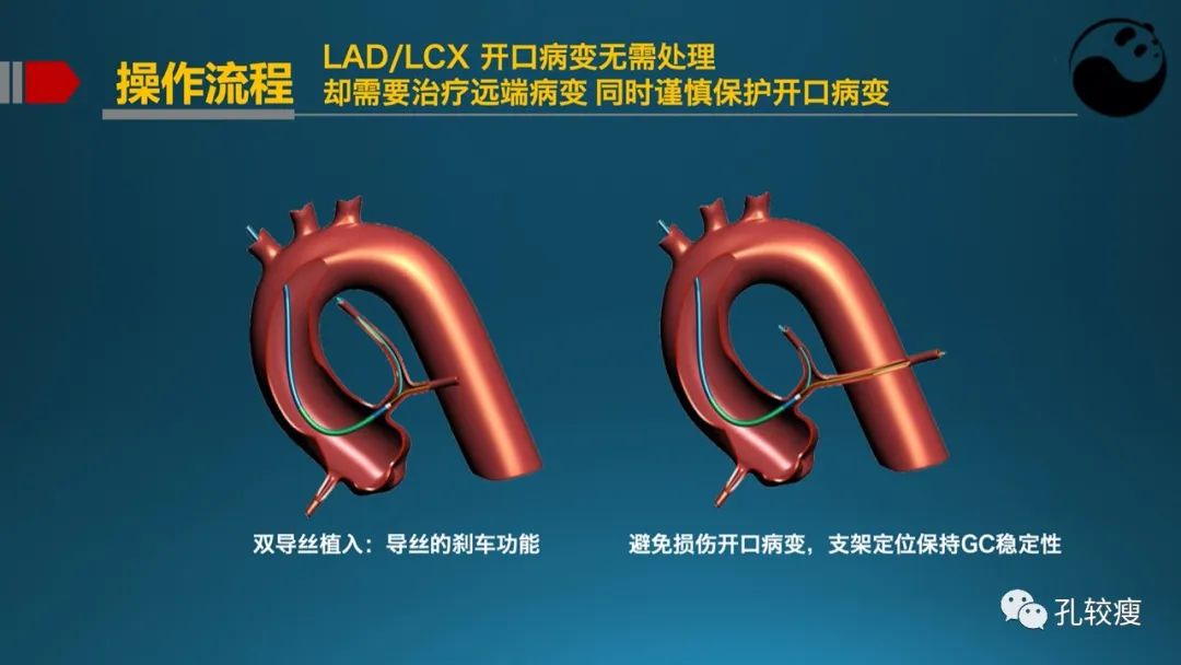左主干指引导管的选择