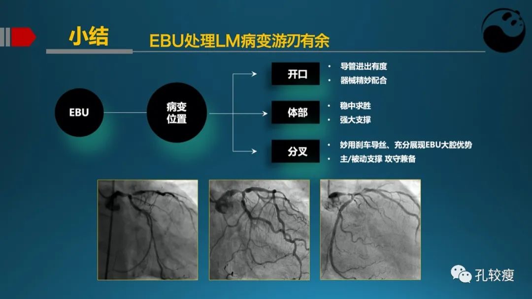 左主干指引导管的选择