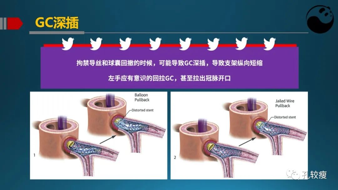 左主干指引导管的选择